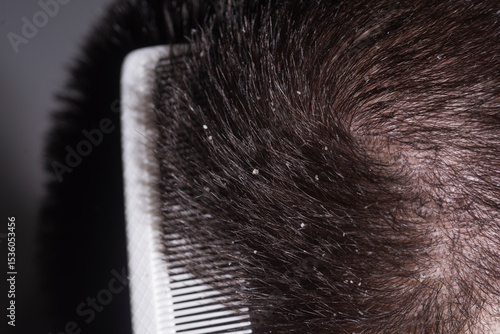 Dermatology shampoo. Dermatitis or eczema. Problem of dandruff. Dandruff hair. Messy hair. Hair with dandruff. Scalp problem, dandruff. Hair disease seborrhea.