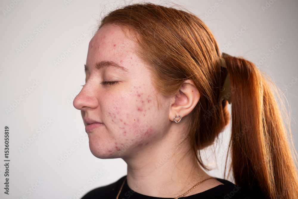 Obraz premium Many pimples. Girl with bad skin. Hormonal acne, puberty. Skin acne background. Closeup acne pimple. Treatment for acne skin. Problem skincare. Pimples, pores, scars. Skincare treatment.