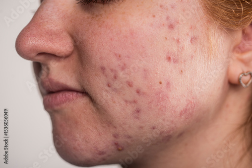 Many pimples. Girl with bad skin. Hormonal acne, puberty. Skin acne background. Closeup acne pimple. Treatment for acne skin. Problem skincare. Pimples, pores, scars. Skincare treatment.