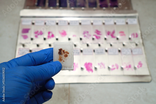 Scientist's hand wearing blue gloves holding a paraffin block of human tissue against a background of a collection of defocused human tissue slides