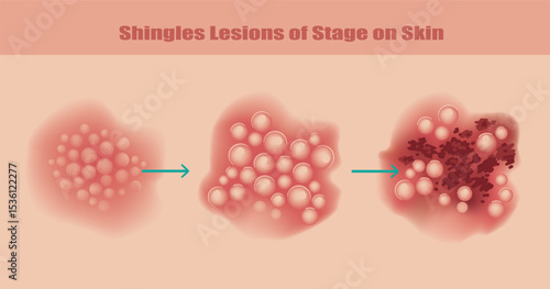 Shingles Lesions of Stage on Skin