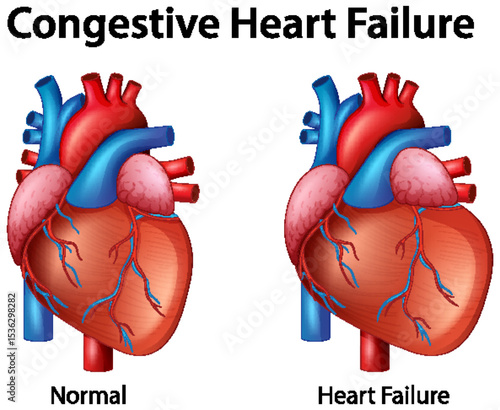 Comparison of Normal and Heart Failure Anatomy