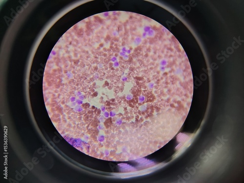 carcinoma cancer cells under microscope