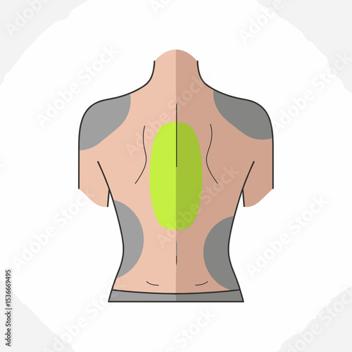 Illustration of a human back showing sunburned areas and skin tone  