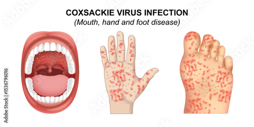 Coxsackie Virus Infection Mouth Hand and Throat Disease