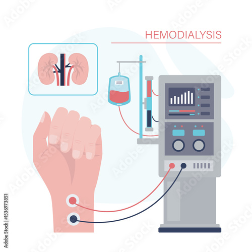 Hemodialysis machine equipment. Kidneys patient treatment in clinic. Clinic blood filter dialysis. Method of extrarenal blood purification in acute and chronic renal failure