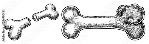 Vector Broken bone depicts a fractured skeletal structure.