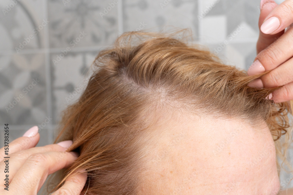 Obraz premium Close-up of woman parting hair to show thinning and sparse growth near hairline. Ideal for topics on hair loss, regrowth, scalp care, or dermatology visuals.
