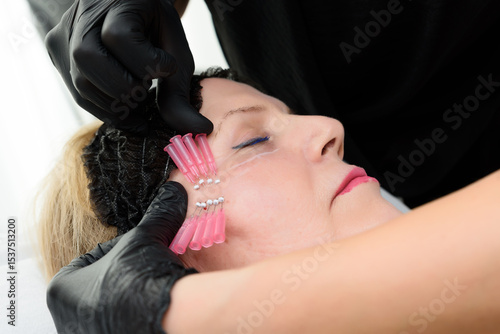 Beautician applying thread lift treatment on woman's face