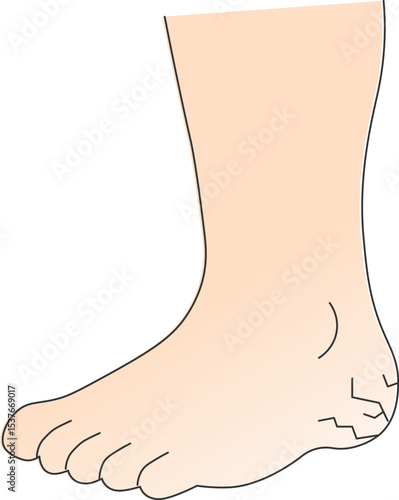Cracked Heel Illustration – Dry Foot
