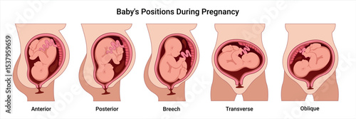 Different baby positions in the uterus during pregnancy. Anterior, Posterior, Breech, Transverse, Oblique positions. Pathology. Detailed medical vector illustration. Fetus with umbilical cord 