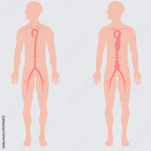 abdominal aortic aneurysm,heart aorta attack, aortic arch bulge open,vein clots stent stroke Marfan root left graft, hernia vessel pain High blood kidney damage Turner, stomach Pain
