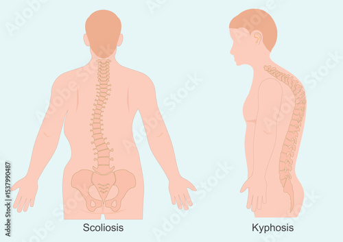 Kyphosis and scoliosis are both spinal conditions.