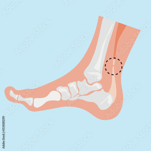 Achilles tendinopathy, human leg ,skeleton ,pain, tendon, medical tendinopathy, rupture, red, disease ,viruses ,disorder, anatomy , inflammation, foot, injury ,rotator cuff,pink