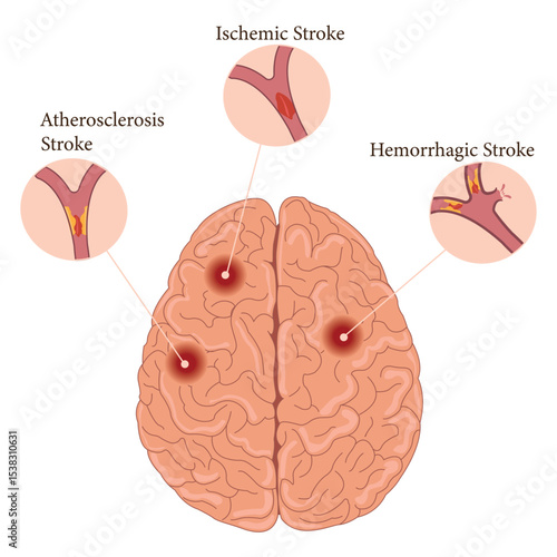 Brain stroke types infographic: ischemic, hemorrhagic, and atherosclerosis stroke illustration