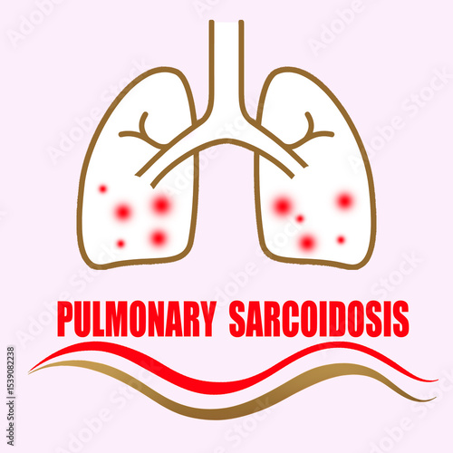 This medical illustration of pulmonary sarcoidosis features a sick lung design, showing the internal damage and inflammation caused by the disease 