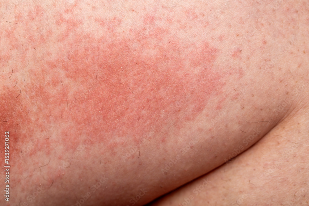 Fototapeta premium Dermatology medical concept. Female leg with allergic reaction. Close up shot of allergic skin irritation with red spots and rash