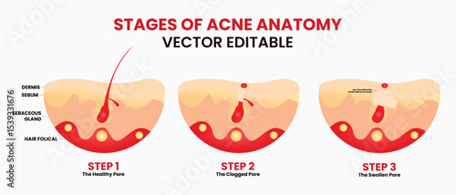 Stage of Acne Anatomy, pimples, skin pores, blackhead, whitehead, scar, comedone. Vector icons of skin acne pimples, cosmetology and skincare problems.