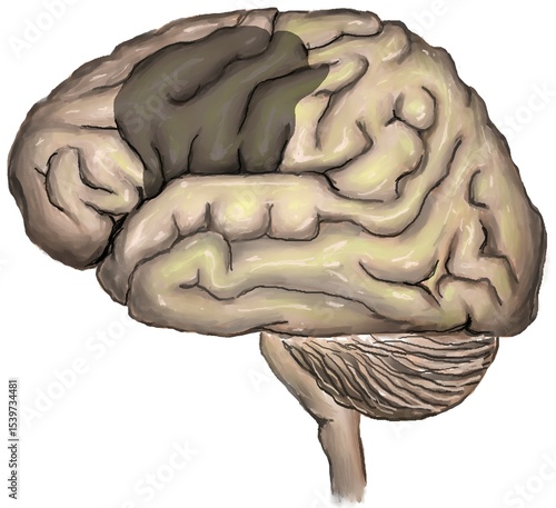 brain lesion in ischemic stroke