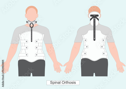 Milwaukee brace or TLSO is a rigid spinal Orthosis.