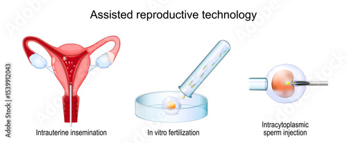 Assisted reproductive technology. In vitro fertilization.