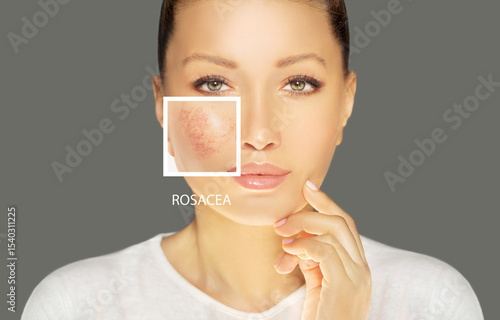 Rosacea ,facial redness.Before and after	