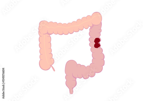 大腸がんの大腸