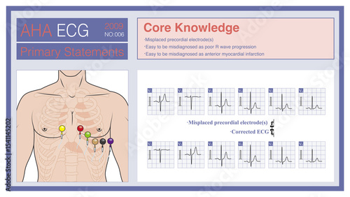 When the electrodes in the chest lead are placed incorrectly, the wrong amplitude evolution of R wave and S wave will occur, which is easy to be misdiagnosed as poor increase of R wave or old AMI.

