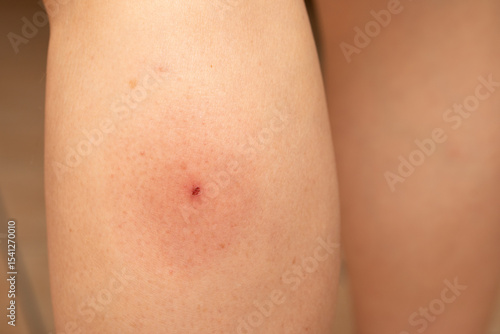 Inflamed tick bite causing redness and irritation on leg skin