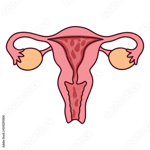 Medical illustration of uterus during menstrual phase. Shows blood shedding from endometrial lining, used in gynecology education and menstrual health awareness