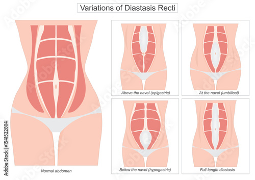 Diastasis recti is a condition where the rectus abdominis the six-pack muscles separate along.