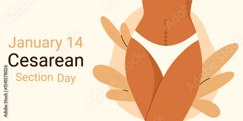 January 14. Cesarean Section Day. Cesarean scar. Stitches after caesarean section on female belly. C-section, surgical delivery operation concept. Isolated vector illustration in cartoon style
