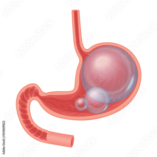 Realistic Abdominal bloated stomach illustration isolated. Transperant ball inside