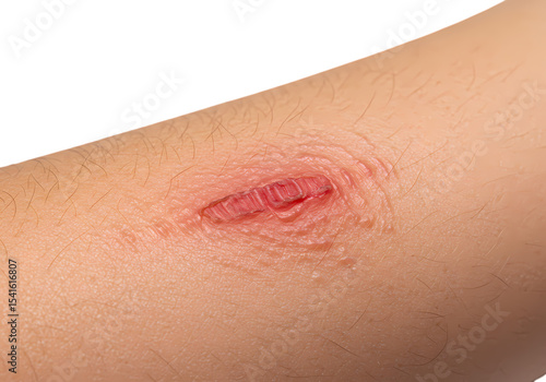 Closeup View of a Minor Abrasion Skin Texture and Healing Process isolated on transparent baackground