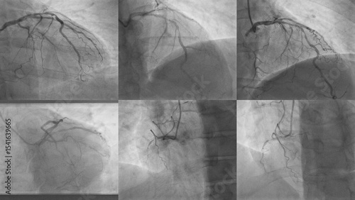 Coronary Angiography – Multiview Visualization of Coronary Artery Disease (CAD)