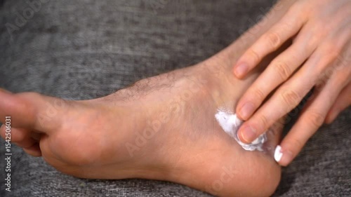 Close-up of man hand apply dense white balm into bruised foot with visible swelling. Concept of applying a repair cream for softening skin, reducing pain and stimulating healing after local trauma