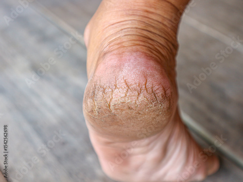 closeup Dry and Cracked Heels. Eczema. Psoriasis. Diabetes mellitus or hypothyroidism