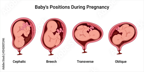 Different baby positions in the uterus during pregnancy. Anterior, Posterior, Cephalic, Breech, Transverse, Oblique positions. Pathology. Detailed medical vector illustration.
