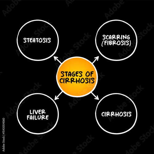 Stages of cirrhosis (scarring of the liver caused by long-term liver damage) mind map text concept