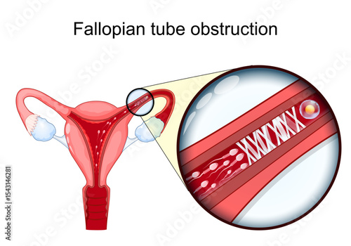 Fallopian tube obstruction. Female infertility