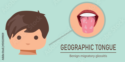Medical vector infographic of geographic tongue in a child, showing pink tongue with smooth patches and glossitis symptoms