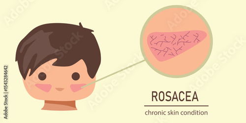 Vector illustration of a child with facial redness caused by rosacea, showing vascular skin texture and chronic condition