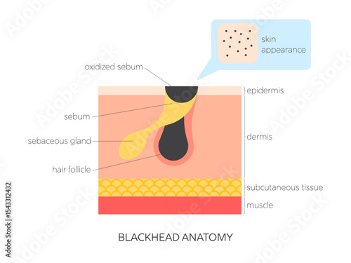 Blackhead (open comedone) flat vector illustration. Medical infographic showing skin structure, sebum buildup, follicle blockage and surface view. Skincare and dermatology concept.