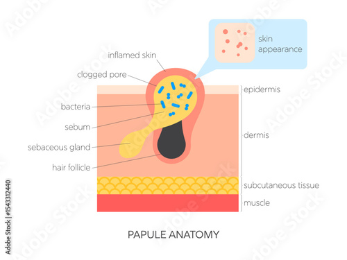 Papule anatomy flat vector illustration. Medical infographic showing skin structure, sebum buildup, inflammation and surface view. Skincare and dermatology concept.