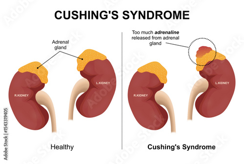 Cushing's syndrome kidney disease illustration