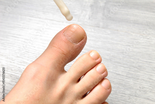 Φωτογραφία Treatment of fungal diseases of the legs