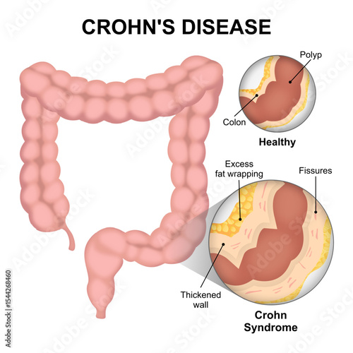 Crohn's Disease, Chronic Inflammatory Bowel Disease (IBD) Illustration
