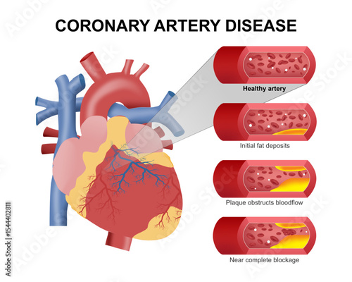 Coronary Artery Disease Heart Illustration