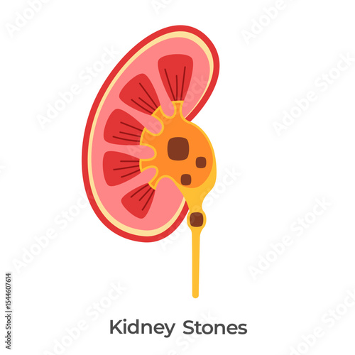 Kidney stones kidneys problem stone clogging urinary anatomy drawing illustration