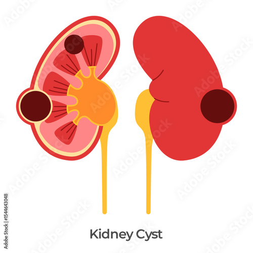 Kidney cyst renal cysts illustration anatomy drawing of fluid filled sacs in kidneys